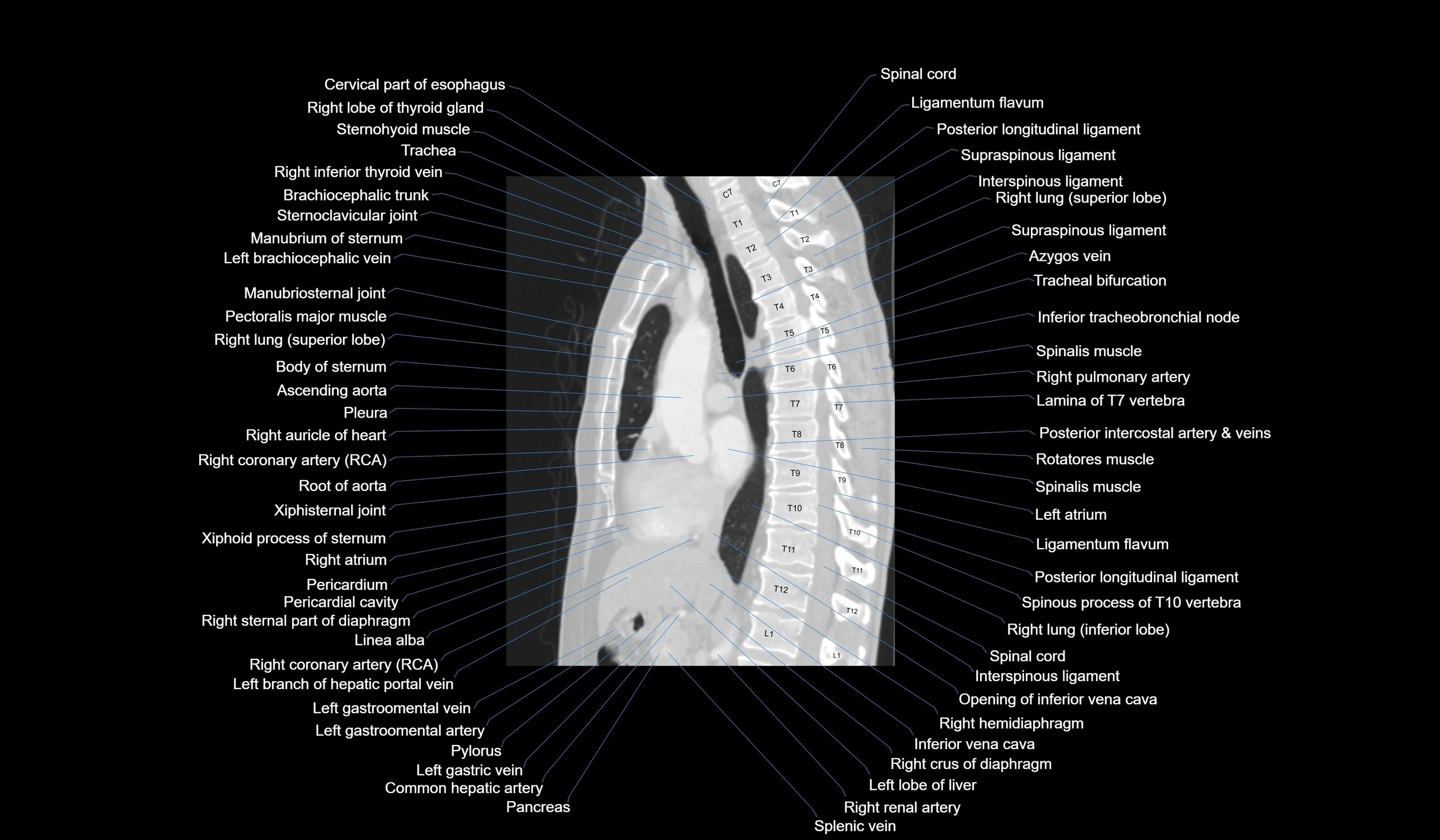 CT chest (thorax) lung window labelled sagittal cross sectional anatomy radiology image-00072.webp